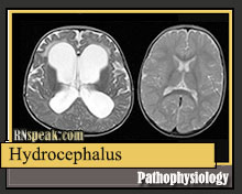 Pathophysiology Of Hydrocephalus In Flow Chart