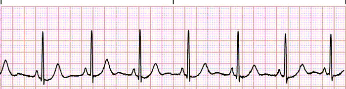 The 6 Steps Method On How To Interpret Electrocardiogram Results Easily Rnspeak